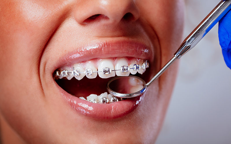 Traditional Braces